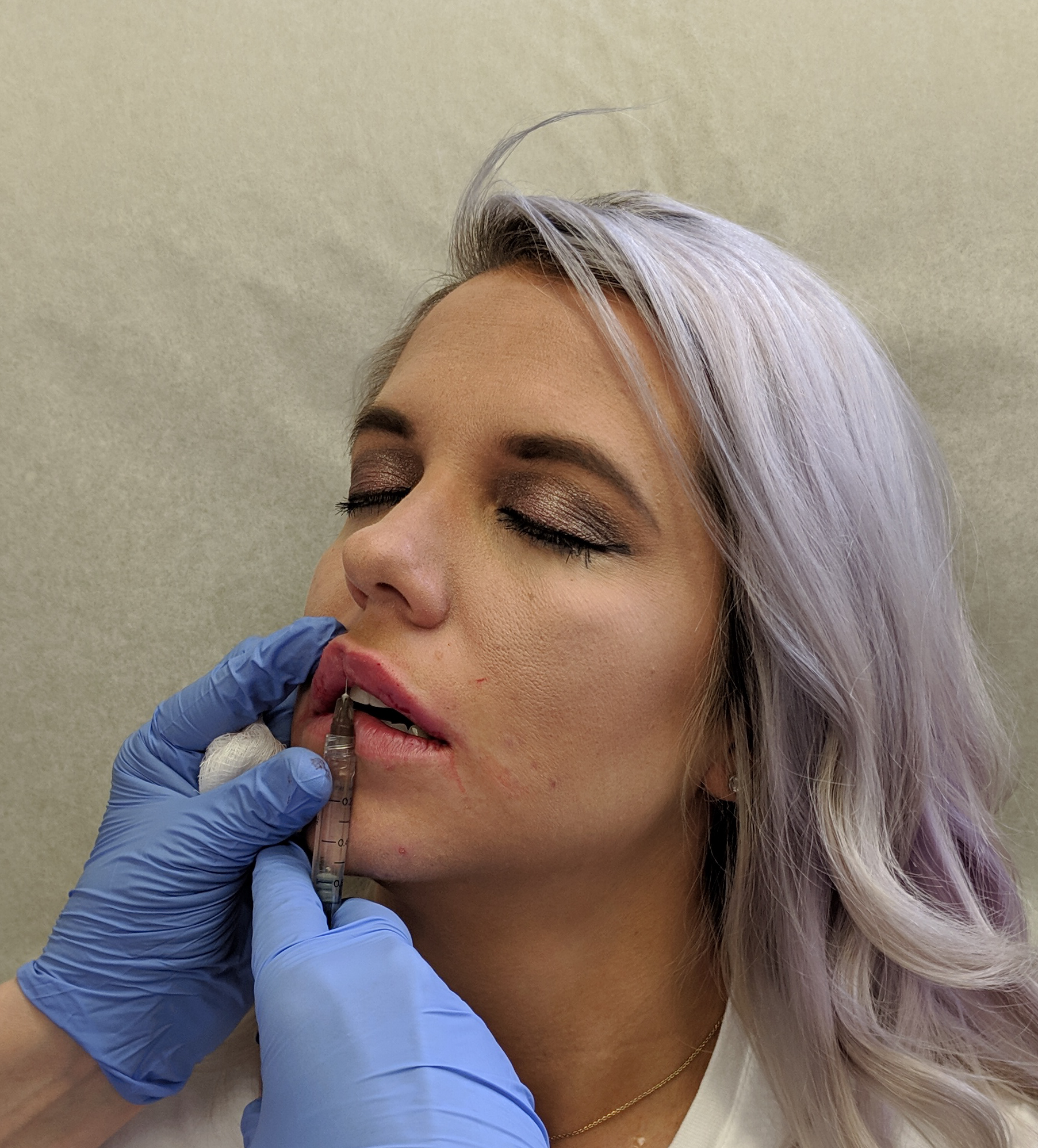 Are Lip Injections Worth It?: A before and after of lip injections using 0.5ml Restylane Defyne lip filler. Do lip injections hurt? What is getting lip injections like? And the best place for lip injections in Kansas City Olathe, Johnson County Dermatology review.
