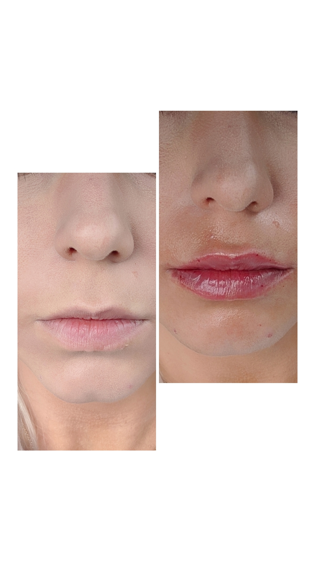 Are Lip Injections Worth It?: A before and after of lip injections using 0.5ml Restylane Defyne lip filler. Do lip injections hurt? What is getting lip injections like? And the best place for lip injections in Kansas City Olathe, Johnson County Dermatology review.