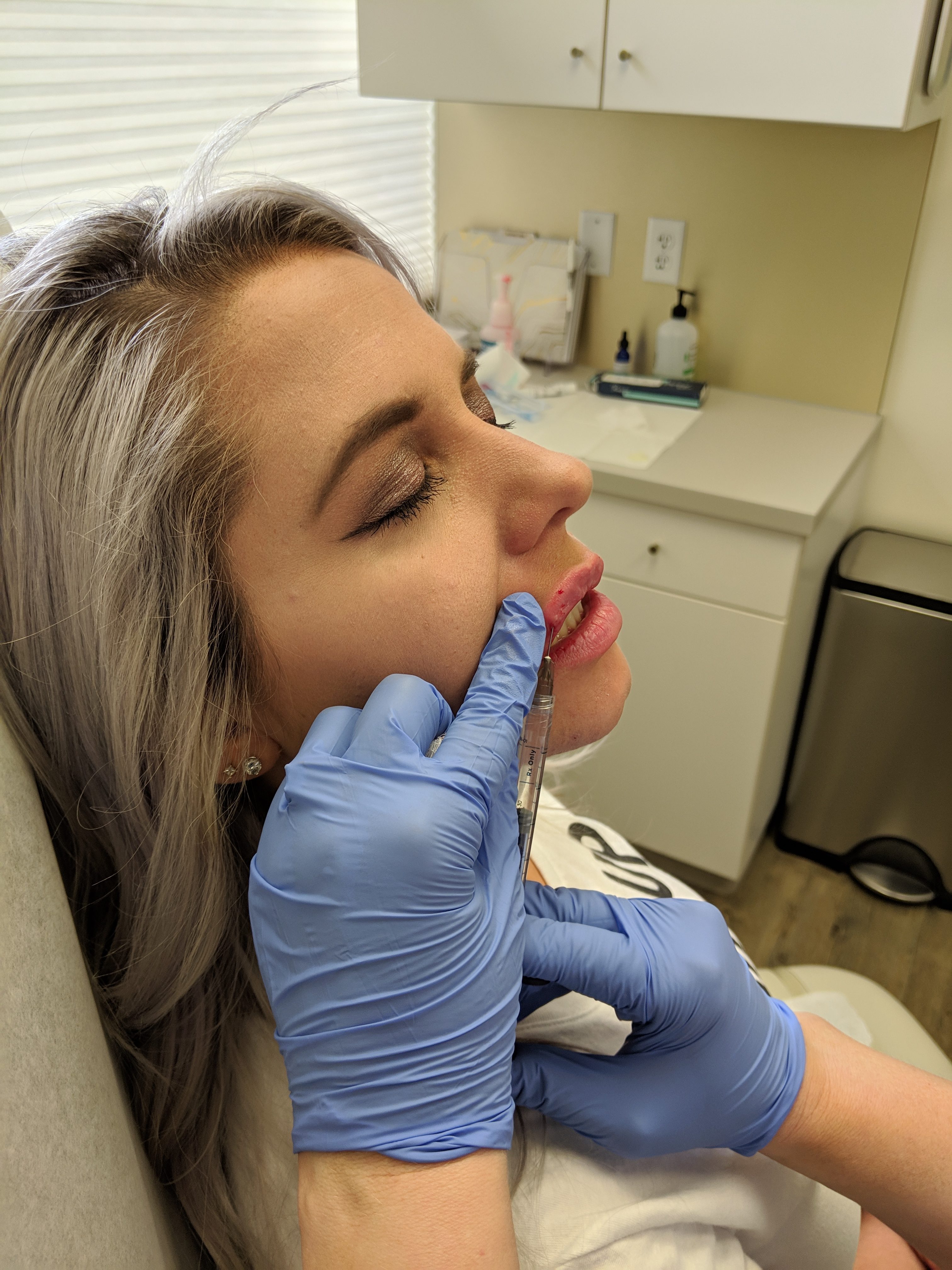 Are Lip Injections Worth It?: A before and after of lip injections using 0.5ml Restylane Defyne lip filler. Do lip injections hurt? What is getting lip injections like? And the best place for lip injections in Kansas City Olathe, Johnson County Dermatology review.