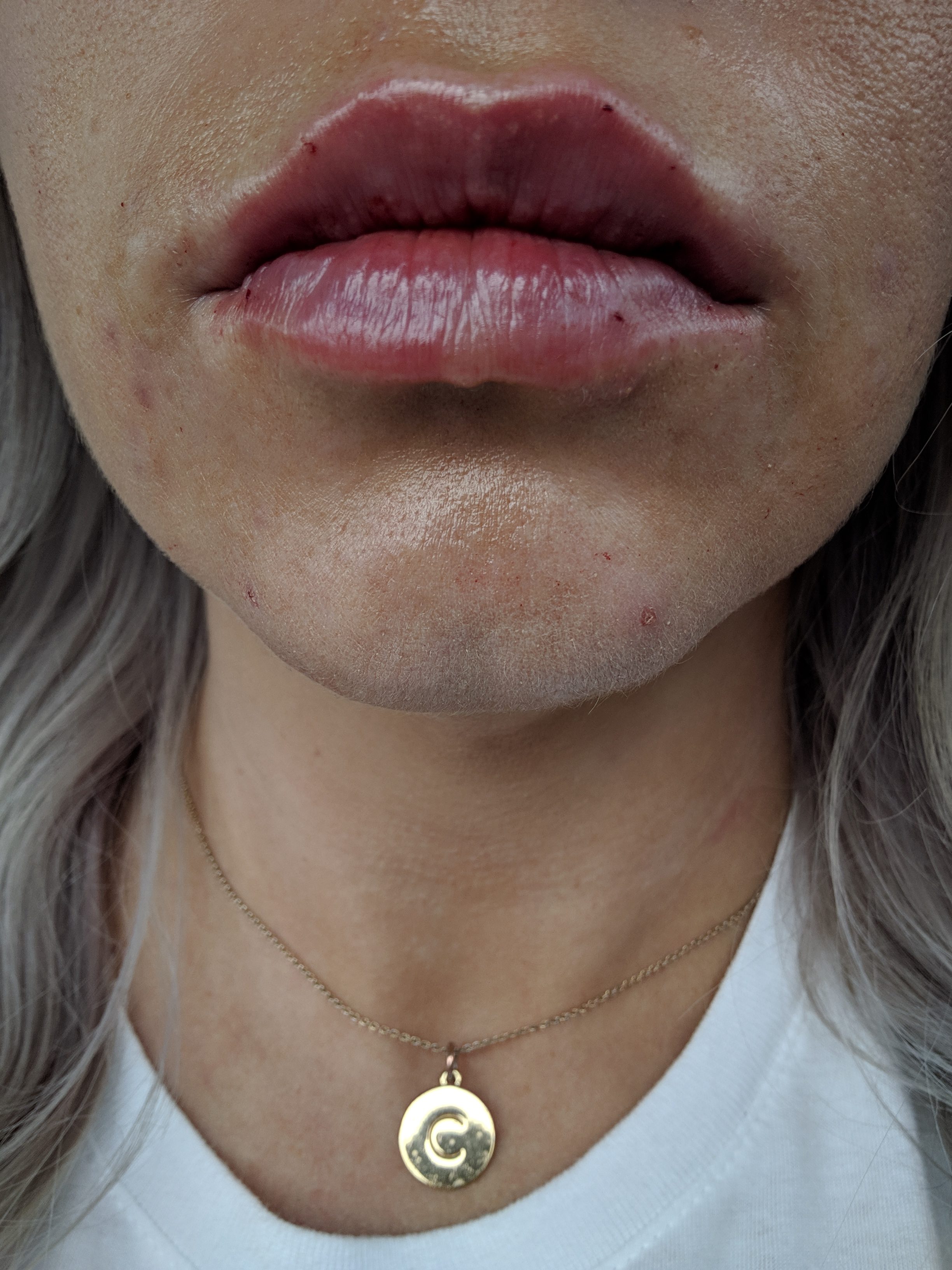 Are Lip Injections Worth It?: A before and after of lip injections using 0.5ml Restylane Defyne lip filler. Do lip injections hurt? What is getting lip injections like? And the best place for lip injections in Kansas City Olathe, Johnson County Dermatology review.
