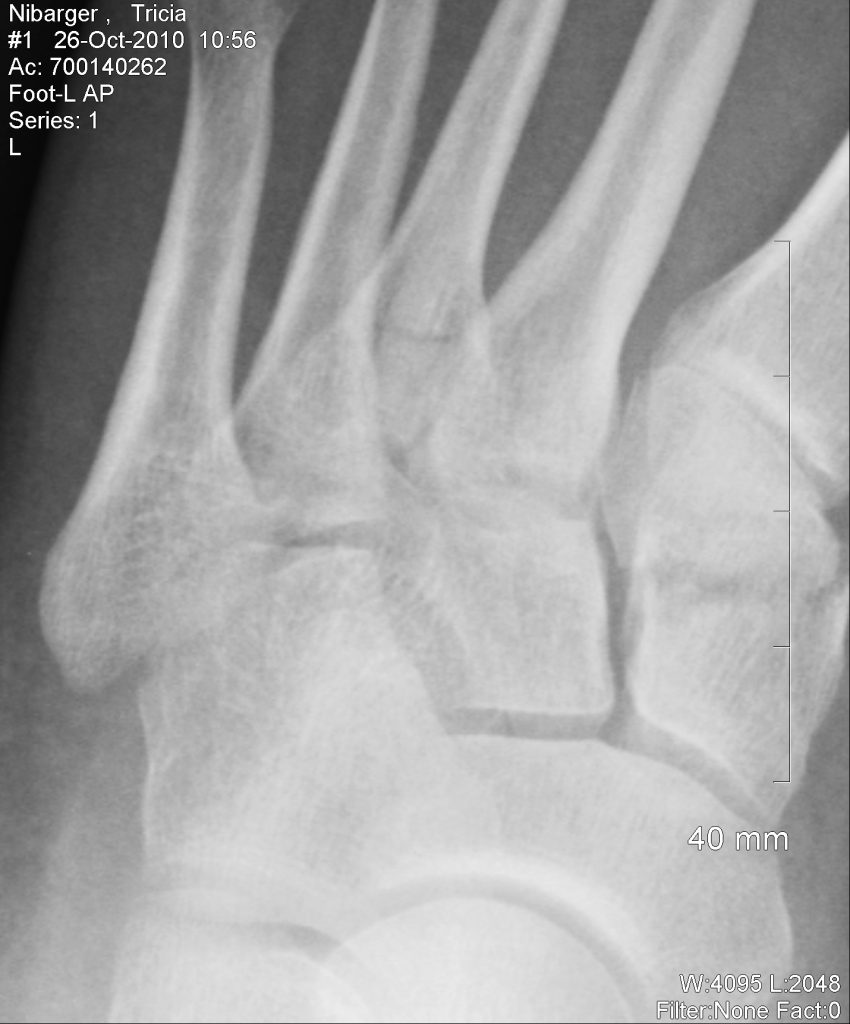 Tricia Broken Foot 10 26 10